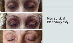 Blefaroplastica non chirurgica - studi