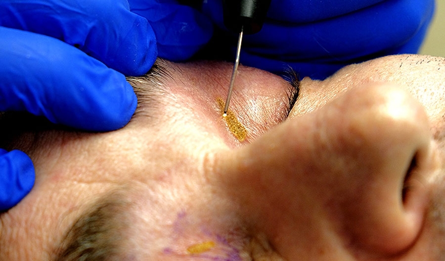 Trattamento Xanthelasma - Studi